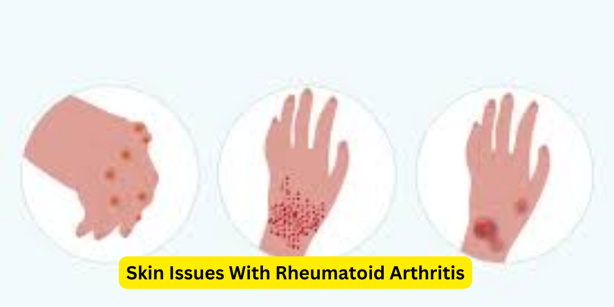 Skin Issues With Rheumatoid Arthritis